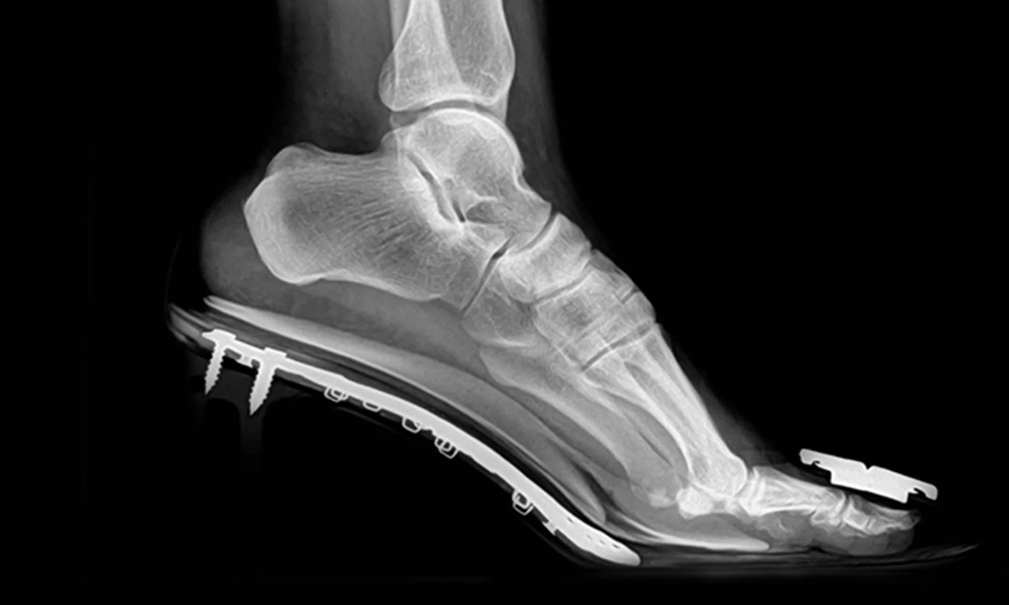 foot-x-ray-with-emar.webp