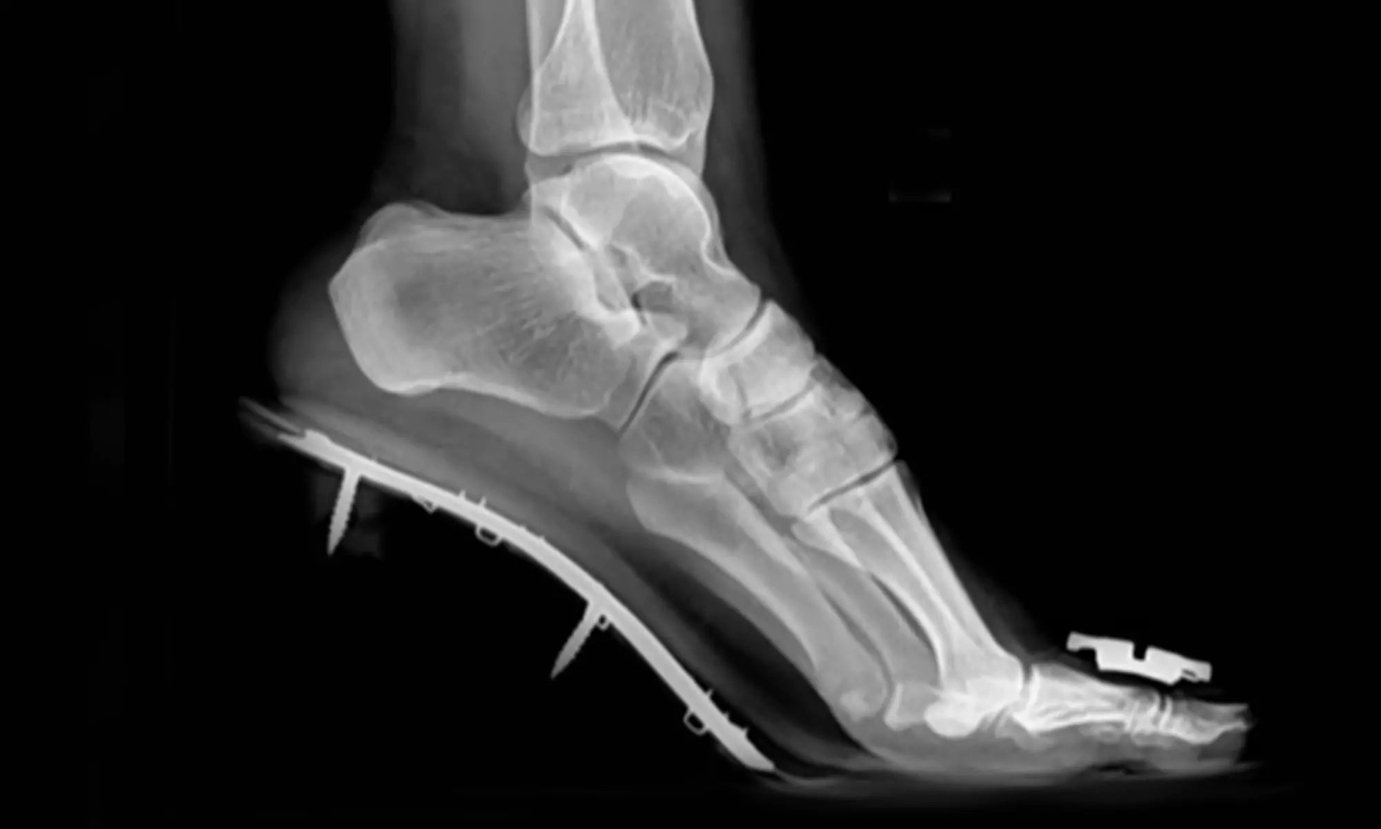 foot-x-ray-without-emar.webp